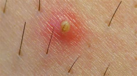 59 HQ Images Ingrown Hair Under Armpit Pictures - How to Prevent ...