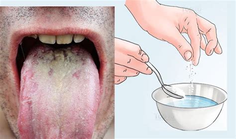 Home Remedies for Oral Thrush | Top 10 Home Remedies