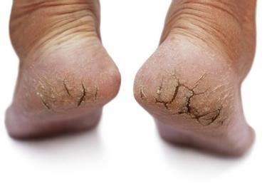 DRY CRACKED HEELS | Foot Medical Centre | Aurora Foot Specialist | Aurora Podiatrist