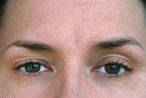 Ptosis Adquirida - Párpados Caídos: Tratamiento