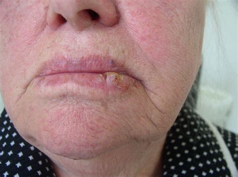 What Does The Beginning Stages Of Lip Cancer Look Like | Sitelip.org