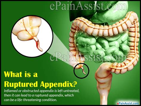 Ruptured Appendix|Causes|Symptoms|Treatment|Signs|Complications