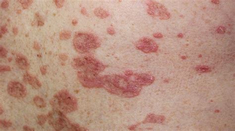 How To Identify Rashes And Other Lupus Skin Symptoms - vrogue.co
