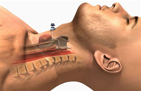 Tracheostomy: Uses, Procedure, Side Effects, and Results