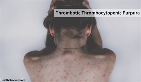 Thrombotic Thrombocytopenic Purpura Symptoms, Causes,Treatment, Life ...