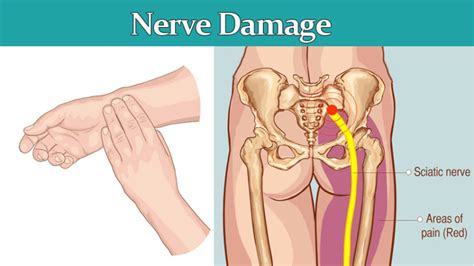 8 Symptoms of Nerve Damage that May be Serious - WomenWorking