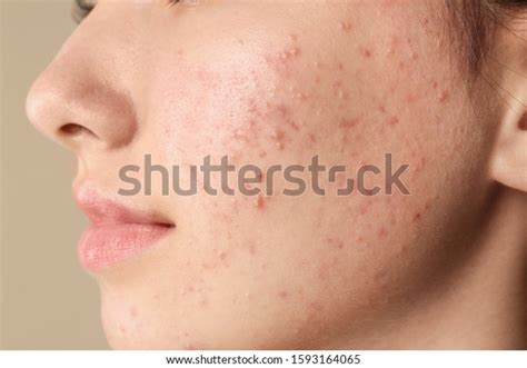 Teenage Girl Acne Problem On Beige Stock Photo 1593164065 | Shutterstock