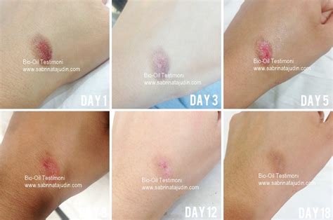 Bio Oil Review on my burned scar | Sabrina Tajudin | Malaysia Beauty ...