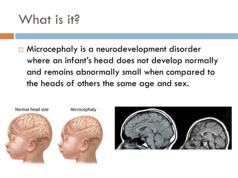 PPT - MICROCEPHALY PowerPoint Presentation, free download - ID:3780061