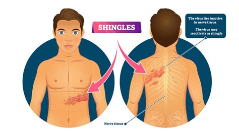 Doctors Explain the Causes and Symptoms of Shingles | Power of Positivity: Positive Thinking ...