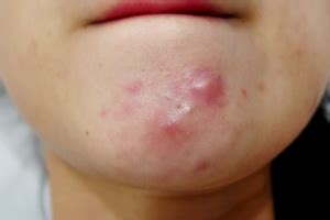 The Differences between Blackheads, White Heads, Milia, Pustules and Cysts. - LEA EIGARD