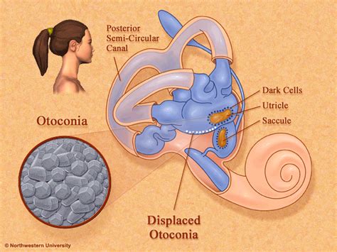 Benign Paroxysmal Positional Vertigo (BPPV) - marcaurel