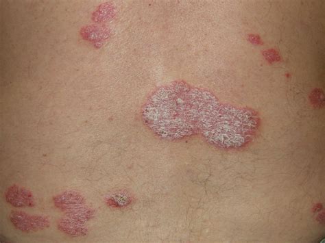 Plaque Psoriasis Pso at David Carr blog