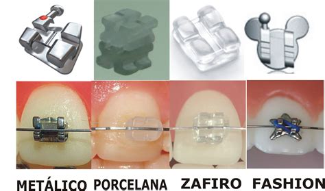 Tipos de brackets. Aparato dental tipos | Tipos de brackets, Cuidado ...