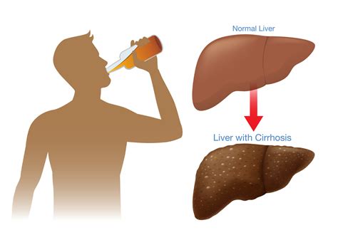 Alcohol Related Liver disease - Early Signs, Treatment and Prevention