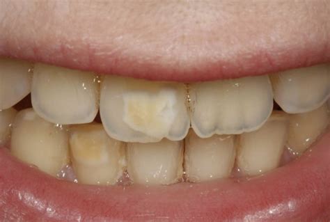 Brown Stains On Teeth – 3 Causes and The Best Solution