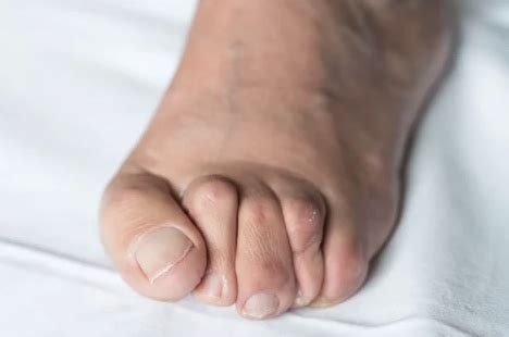 SURGERY FOR LESSER TOE DEFORMITY - Midwest Orthopaedics