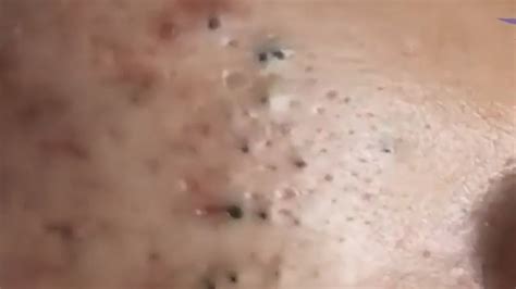 Extreme Blackhead Popping Youtube 2024 New Videos Youtube - Alfy Louisa