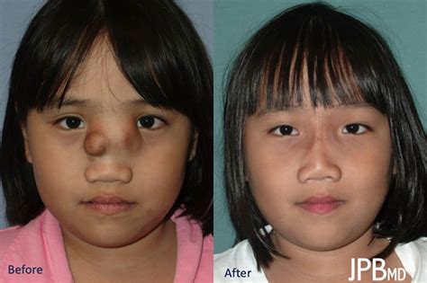 Craniofacial - Before & Afters - James P Bradley, MD