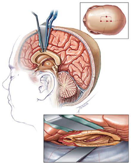 Epilepsy Surgery | Neupsy Key