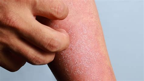 All You're Itching to Know About Atopic Dermatitis