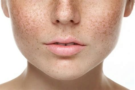 Best Face Skin Pigmentation treatment in Mumbai, Hyperpigmentation Cost India