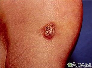 Kaposi sarcoma - lesion on the foot: MedlinePlus Medical Encyclopedia Image