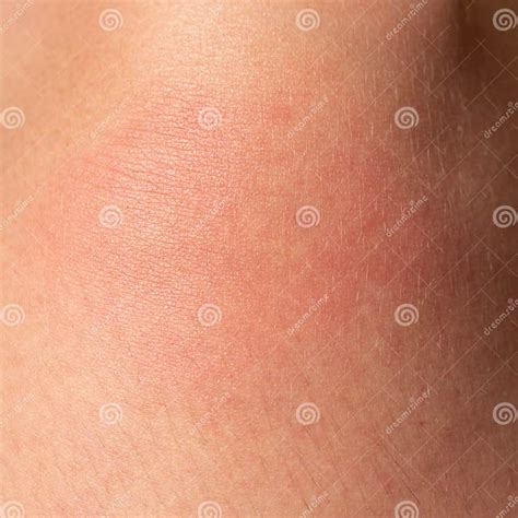 Allergy on the Human Body and Redness from a Wasp Sting. Stock Photo - Image of bite, person ...