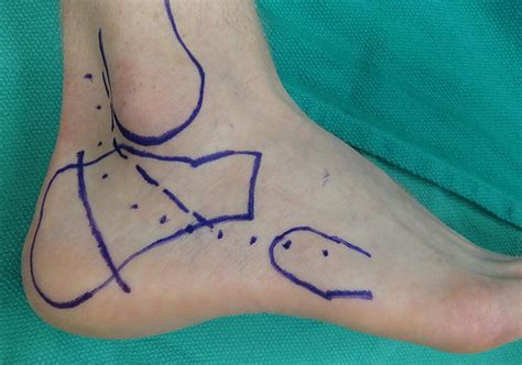 Surgical Technique for Combined Dwyer Calcaneal Osteotomy and Peroneal Tendon Repair for ...