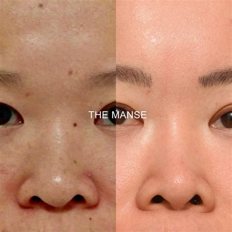 Freckle and Mole Removal Asian Skin - Best Cosmetic Clinic Sydney. Advanced practitioners