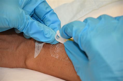 8.6 Converting an IV Infusion to a Saline Lock and Removal of a Peripheral IV – Clinical ...