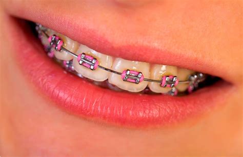 Is Pink A Good Braces Color – Warehouse of Ideas