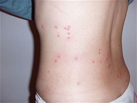 Flea Allergy Dermatitis On Humans