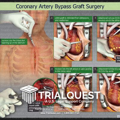 Coronary Artery Bypass Graft Surgry - TrialExhibits Inc.