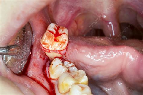 How To Clean Mouth After Wisdom Teeth Extraction at brendanrallison blog