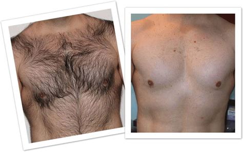 men-hair-chest-before-after (1) (1) | Shahnaz's Beauty Garden Hair & Spa