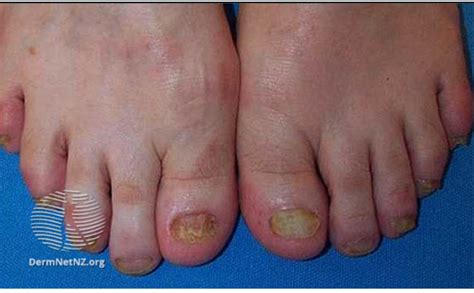 Dermatophyte Infection Fingernail or Toenail - HSE.ie