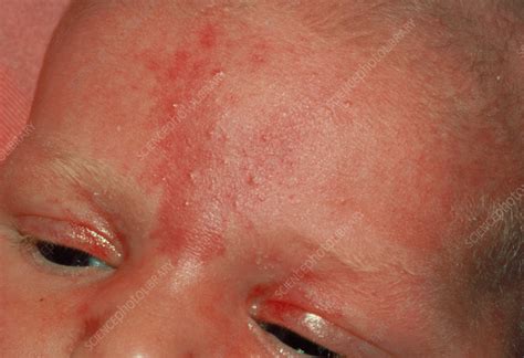 Stork mark birthmark on baby's forehead - Stock Image - M170/0180 ...