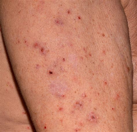 Scabies Treatment: Topical Medications Vs Scabicide Therapy ...