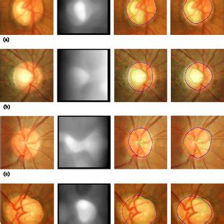 (PDF) Determination of cup-to-disc ratio of optical nerve head for ...