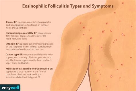 Eosinophilic Folliculitis: Symptoms, Treatment, and More