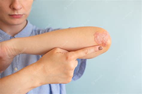 Psoriasis vs Ringworm: What's the Difference and How to Tell Them Apar | PurClarity Skincare