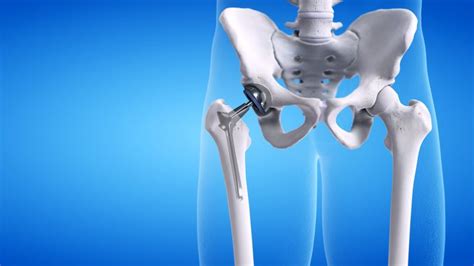 Hip replacement surgery: Here's what you need to know | Intellijoint Surgical