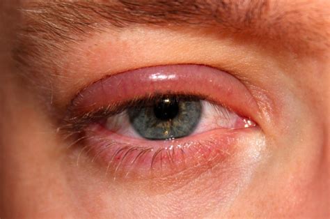 Swollen eyelid - What is it and how do I treat it? | Eye Health