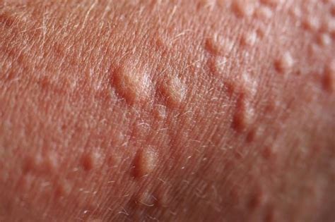 Bumps on Skin: Skin Mysteries Explained | Reader's Digest