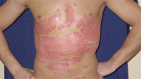 Psoriasis Pictures Hd Signs Symptoms Images Photos And Pictures Of Images