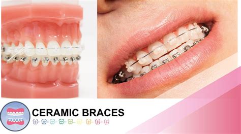 Ceramic Braces 1 in Sydney | OrthoBoutique