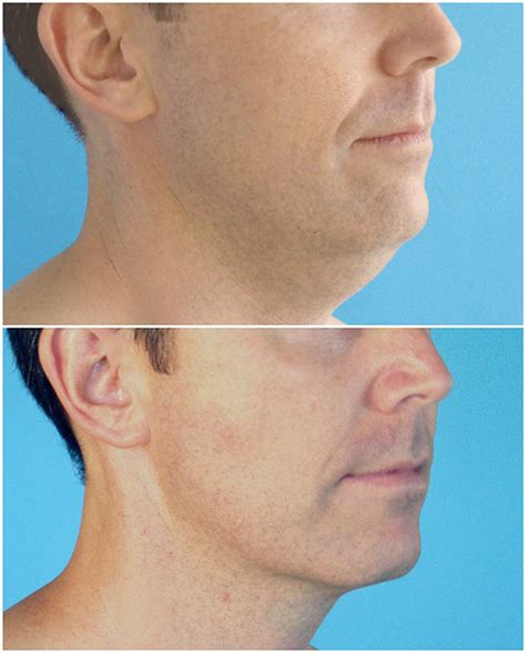 Vaser Liposuction for Men | Liposuction for double chin reduction, Neck Lipo