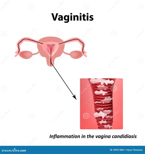 Vaginitis. Inflammation in the Vagina Candidiasis Thrush. the Structure of the Pelvic Organs ...