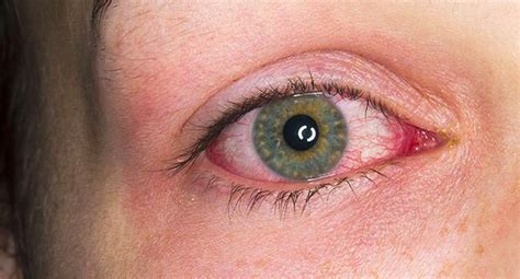 Uveitis: Causes, Symptoms, Treatments, 55% OFF